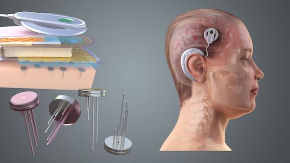 Diagram of brain implants unlike the software enhancements in this dystopian techno-thriller