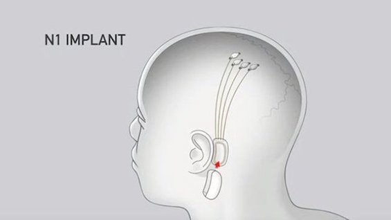 Artist's sketch of a brain implant like those in this novel about brain implants